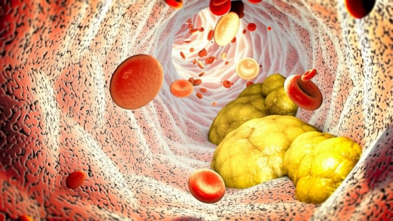 Study Reveals: Elevated Bad Cholesterol May Extend Life for Elderly in Sardinia